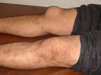 Bursitis