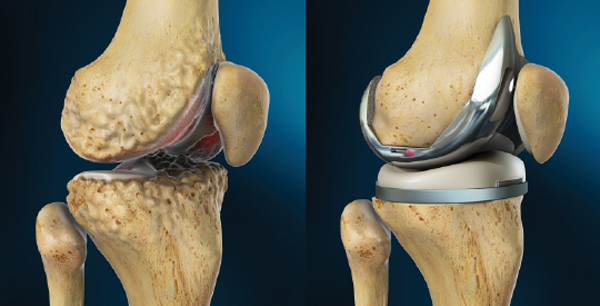 Knee Replacement