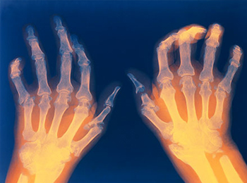 Rheumatoid Arthritis