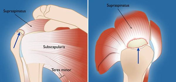 Rotator Cuff Surgery