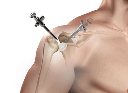 Shoulder Arthroscopy